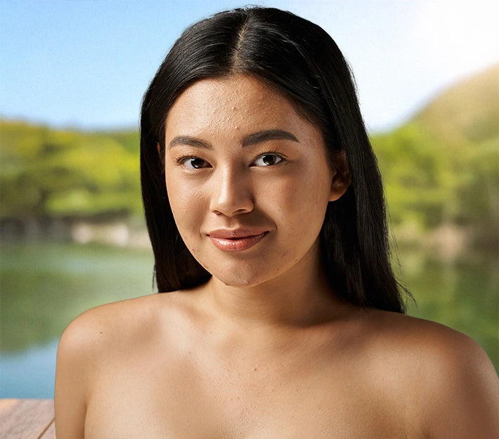 Young woman with acne-prone skin embracing natural skincare, showcasing a healthy and confident glow.